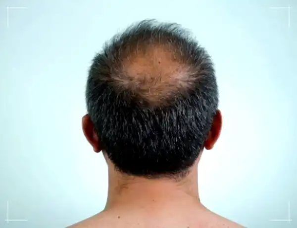Hair-Loss-1.webp