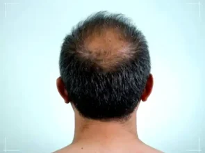 Hair Loss, Grow Fully Live Hair for the First Time